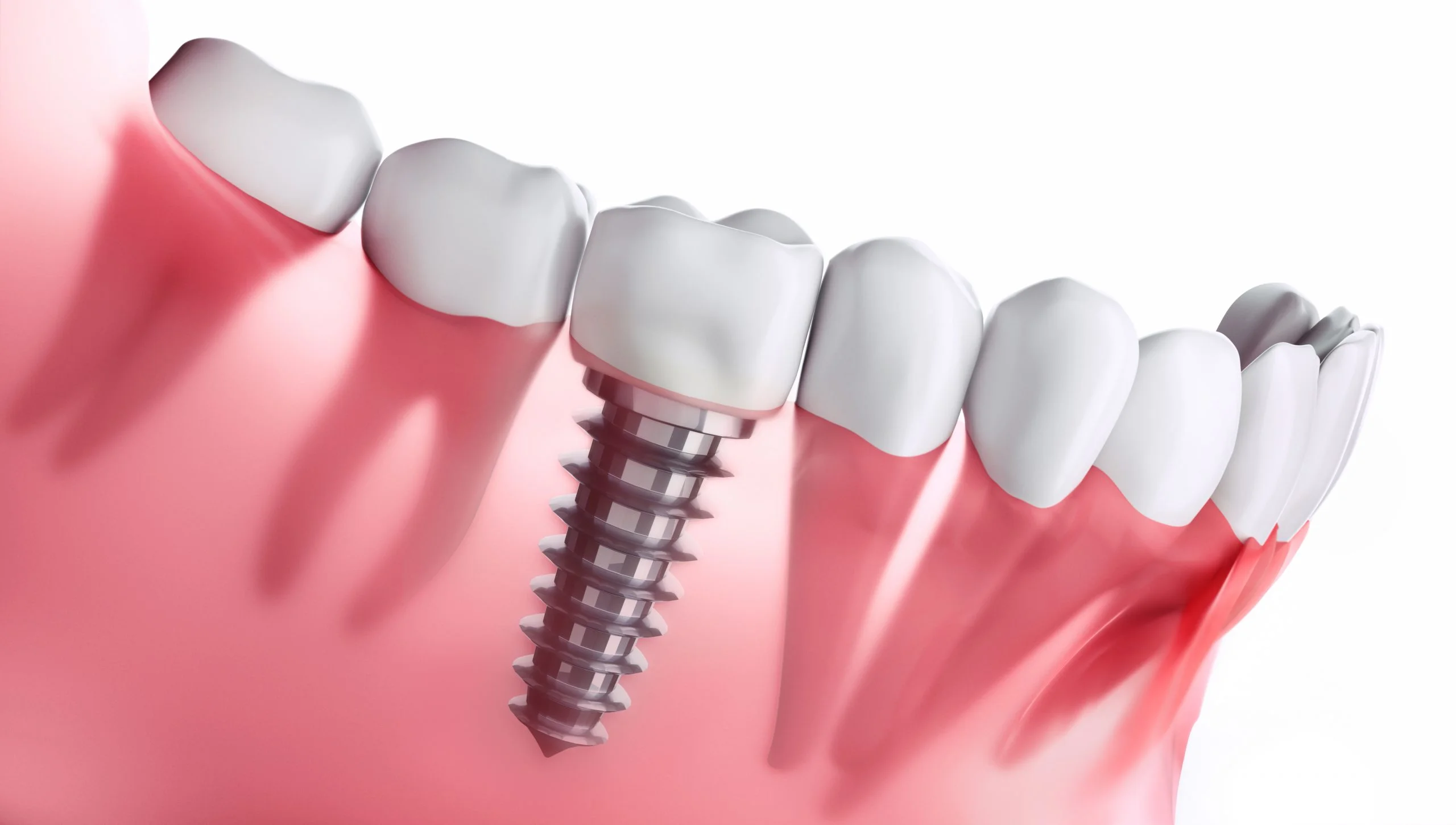 woodstock dentistry, woodstock dentist, Fixed-and-removable-prosthesis woodstock