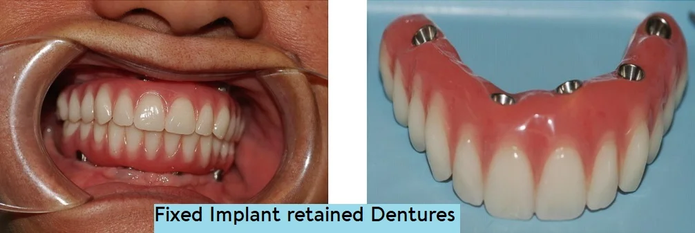 woodstock dentistry, woodstock dentist, Crowns & Veneers Woodstock NB